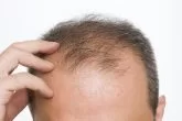 sudden-hair-loss-maharashtra